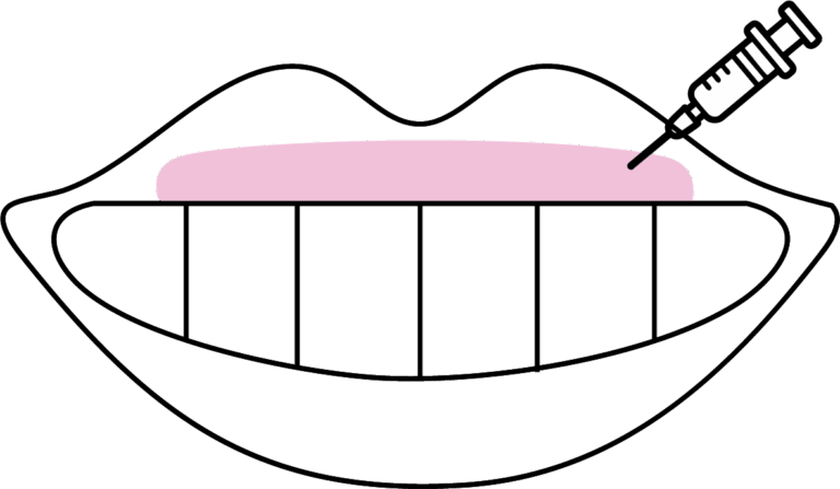 Afbeelding van behandeling Botox gummysmile tandvleeslach