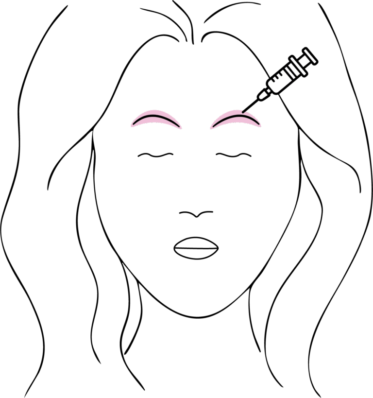 Afbeelding van behandeling Botox wenkbrauwlift