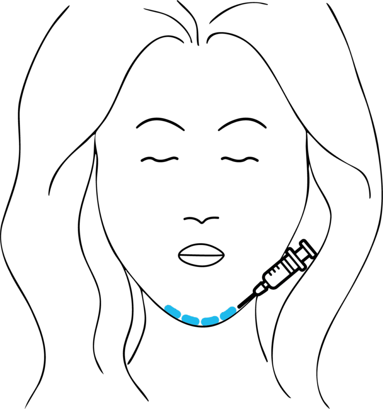 Afbeelding van behandeling Fillers kin
