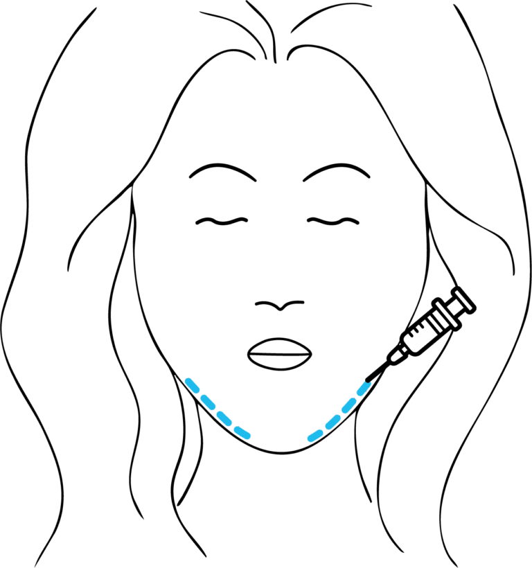 Afbeelding van behandeling Kaaklijnverstrakking
