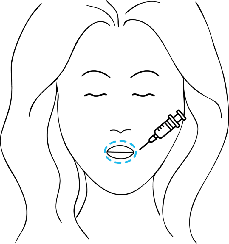 Afbeelding van behandeling Lippen opvullen