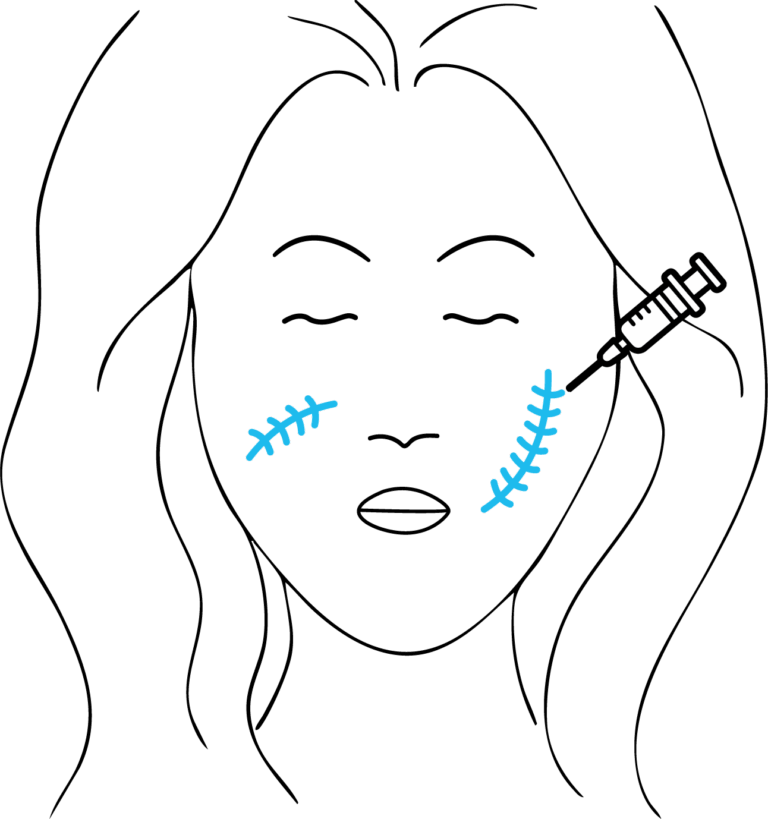 Afbeelding van behandeling Littekens