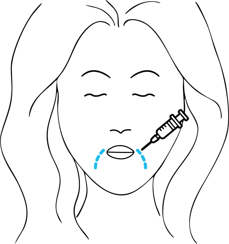 Afbeelding van behandeling Marionetten lijnen