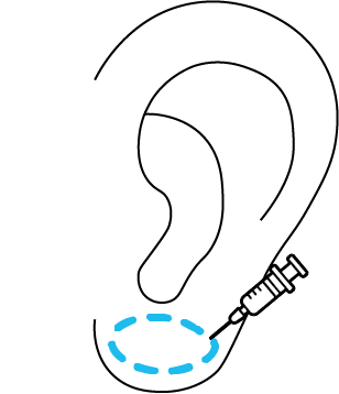 Afbeelding van behandeling Oorlelcorrectie