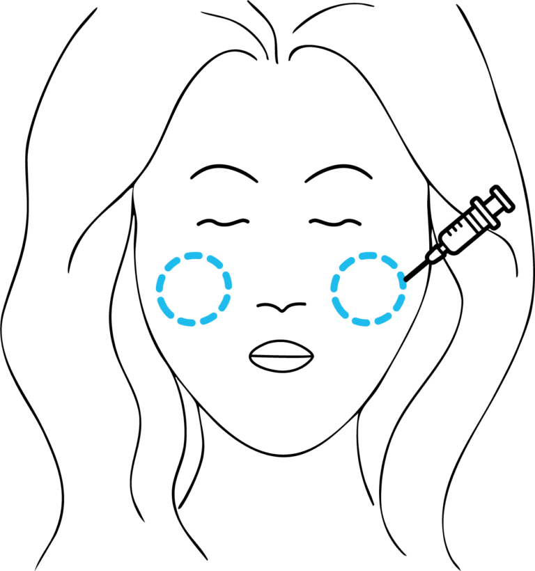 Afbeelding van behandeling Wangen