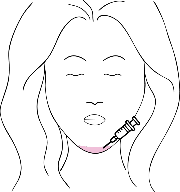 Afbeelding van behandeling Botox kin