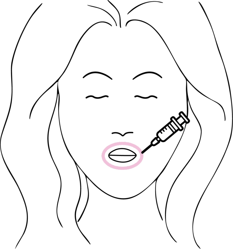 Afbeelding van behandeling Liplijntjes