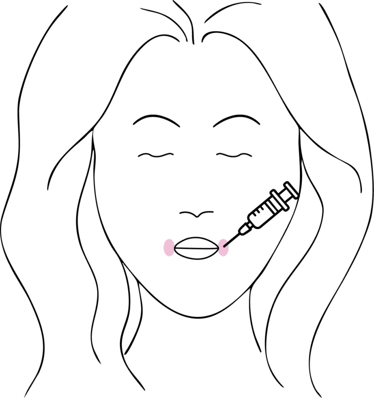 Afbeelding van behandeling Mondhoeken