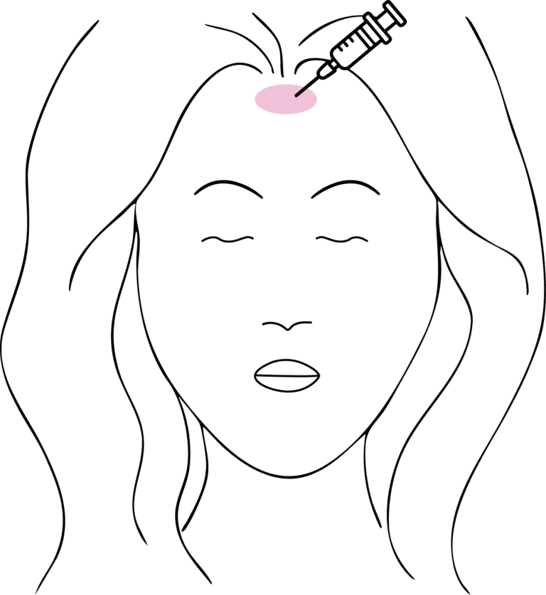 Afbeelding van behandeling Botox tegen migraine